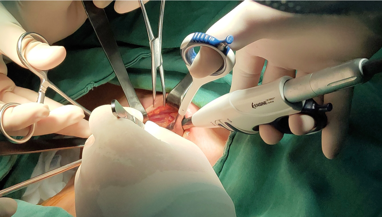 超聲切割止血刀  盈甲 	EG US-STAR